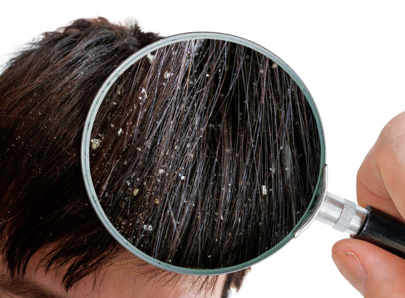 Anti-Dandruff 